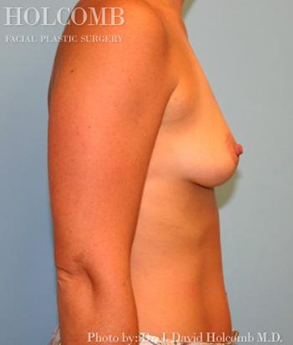 Breast Augmentation Before & After Gallery - Patient 6236665 - Image 5