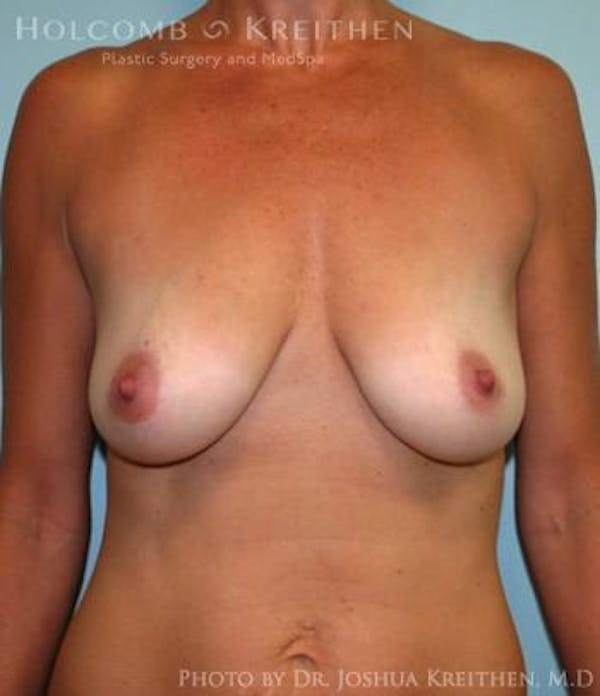 Breast Augmentation with Lift Before & After Gallery - Patient 6276460 - Image 1