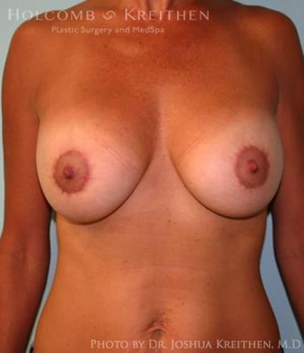 Breast Augmentation with Lift Before & After Gallery - Patient 6276460 - Image 2