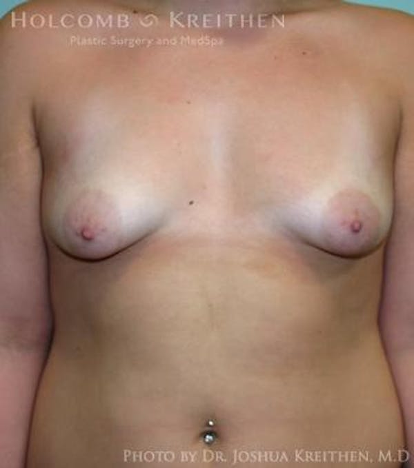 Breast Augmentation with Lift Gallery - Patient 6276462 - Image 1