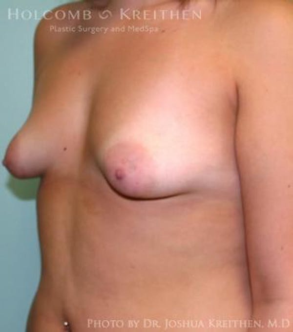 Breast Augmentation with Lift Gallery - Patient 6276462 - Image 3