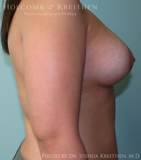Breast Augmentation with Lift Gallery - Patient 6276462 - Image 6