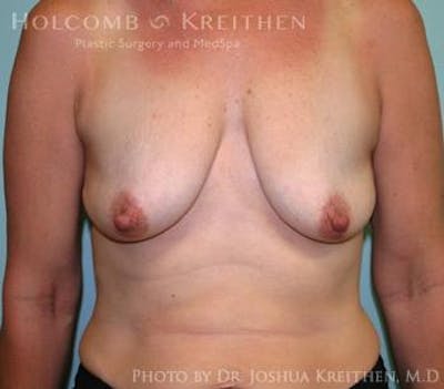 Breast Augmentation with Lift Before & After Gallery - Patient 6276465 - Image 1
