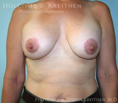 Breast Augmentation with Lift Before & After Gallery - Patient 6276465 - Image 2