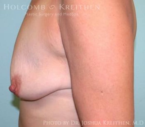 Breast Augmentation with Lift Gallery - Patient 6276465 - Image 3
