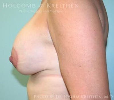 Breast Augmentation with Lift Before & After Gallery - Patient 6276465 - Image 4