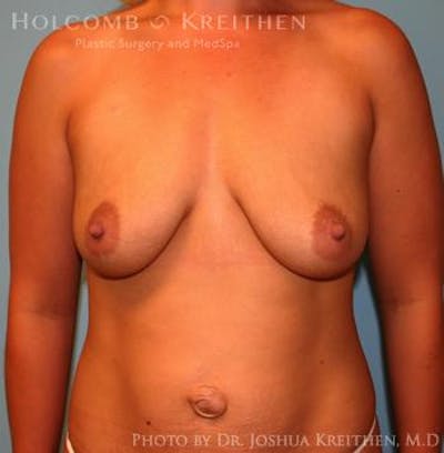 Breast Augmentation with Lift Gallery - Patient 6276467 - Image 1