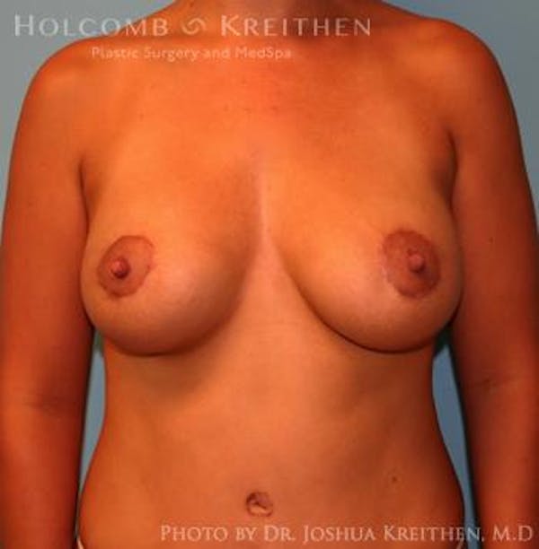 Breast Augmentation with Lift Before & After Gallery - Patient 6276467 - Image 2