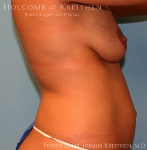 Breast Augmentation with Lift Before & After Gallery - Patient 6276467 - Image 5