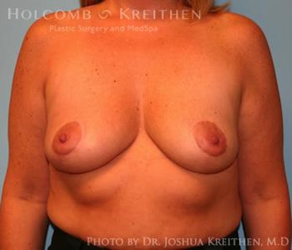 Breast Augmentation with Lift Before & After Gallery - Patient 6276468 - Image 1