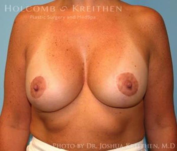 Breast Augmentation with Lift Before & After Gallery - Patient 6276468 - Image 2