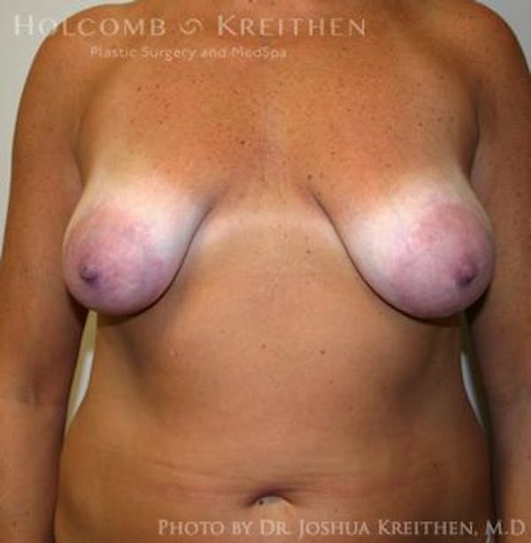 Breast Augmentation with Lift Before & After Gallery - Patient 6276469 - Image 1