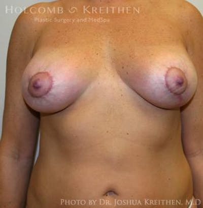 Breast Augmentation with Lift Before & After Gallery - Patient 6276469 - Image 2