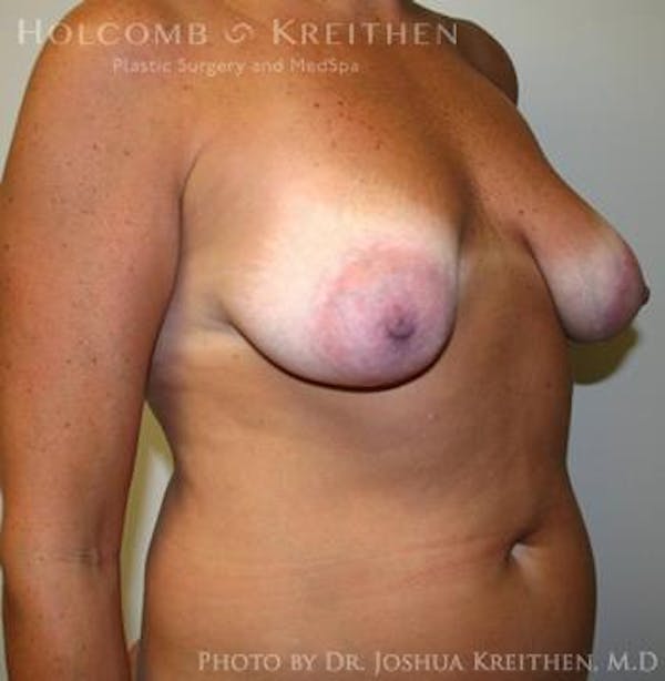 Breast Augmentation with Lift Before & After Gallery - Patient 6276469 - Image 3