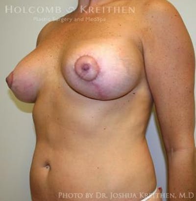 Breast Augmentation with Lift Gallery - Patient 6276469 - Image 6