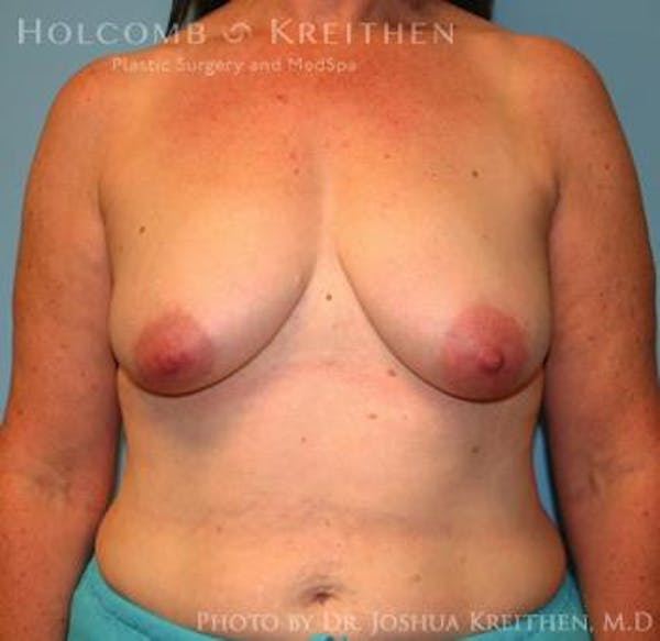 Breast Augmentation with Lift Before & After Gallery - Patient 6276470 - Image 1