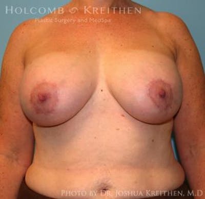 Breast Augmentation with Lift Gallery - Patient 6276470 - Image 2