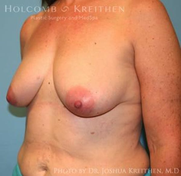 Breast Augmentation with Lift Before & After Gallery - Patient 6276470 - Image 3