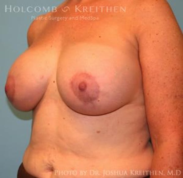 Breast Augmentation with Lift Gallery - Patient 6276470 - Image 4