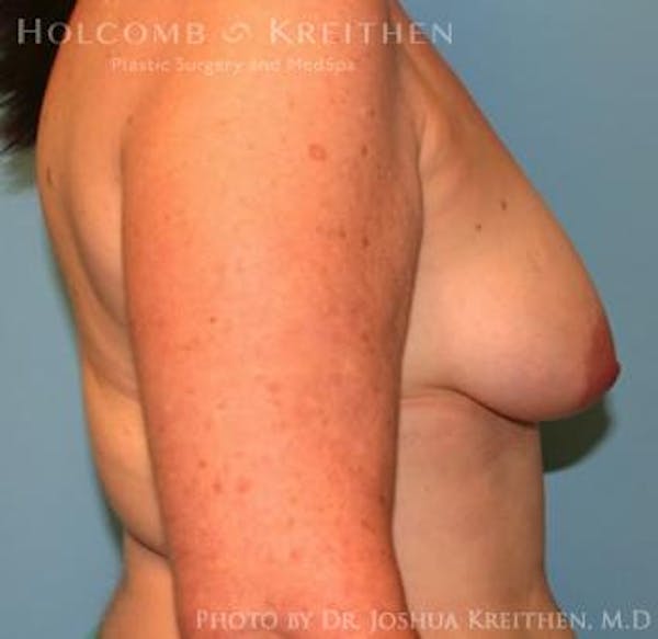 Breast Augmentation with Lift Before & After Gallery - Patient 6276470 - Image 5