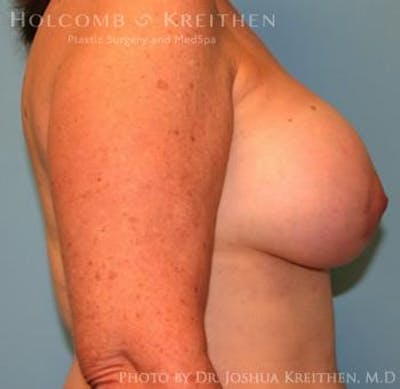 Breast Augmentation with Lift Before & After Gallery - Patient 6276470 - Image 6