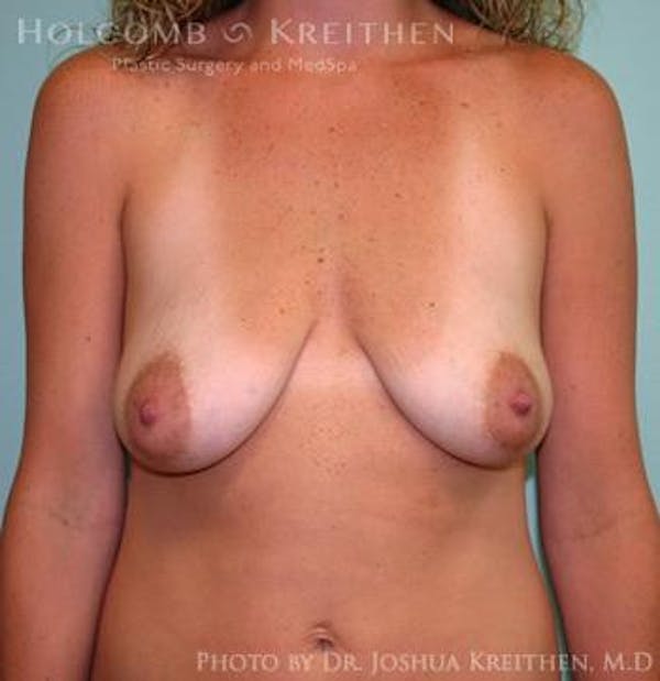 Breast Augmentation with Lift Gallery - Patient 6276472 - Image 1