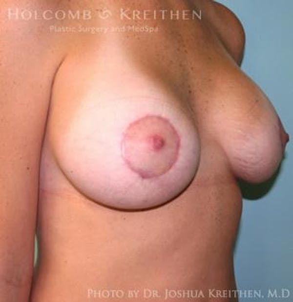 Breast Augmentation with Lift Before & After Gallery - Patient 6276472 - Image 4