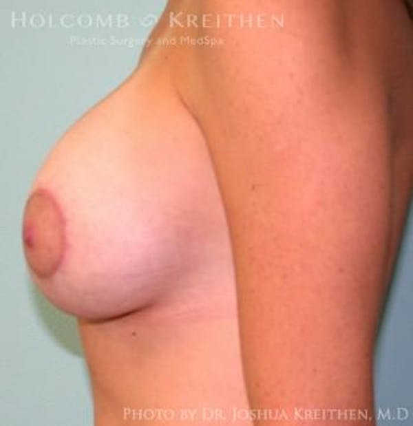 Breast Augmentation with Lift Before & After Gallery - Patient 6276472 - Image 6