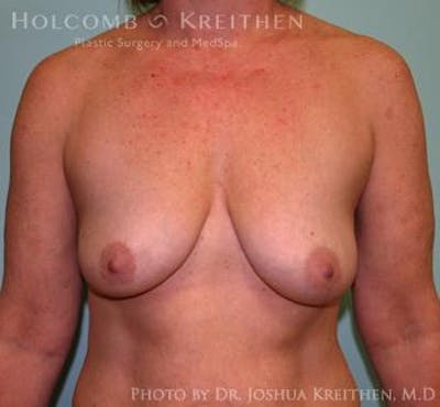 Breast Augmentation with Lift Gallery - Patient 6276476 - Image 1