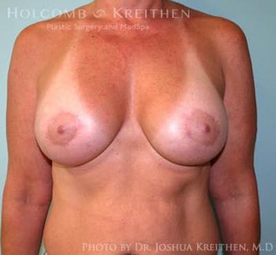Breast Augmentation with Lift Before & After Gallery - Patient 6276476 - Image 2