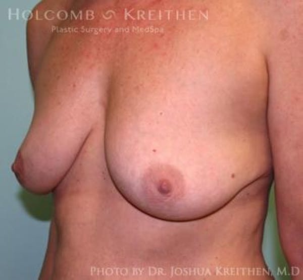 Breast Augmentation with Lift Gallery - Patient 6276476 - Image 3
