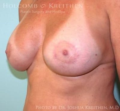 Breast Augmentation with Lift Before & After Gallery - Patient 6276476 - Image 4
