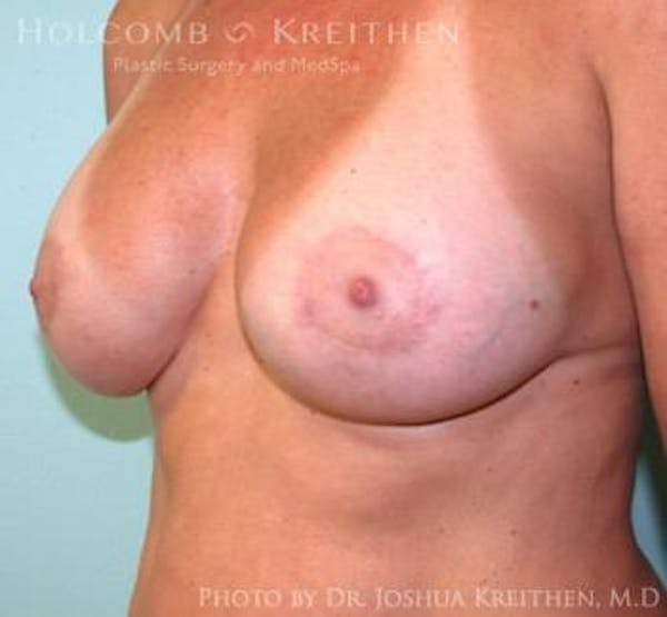 Breast Augmentation with Lift Gallery - Patient 6276476 - Image 4