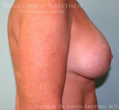 Breast Augmentation with Lift Before & After Gallery - Patient 6276476 - Image 6