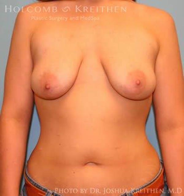 Breast Augmentation with Lift Before & After Gallery - Patient 6276478 - Image 1