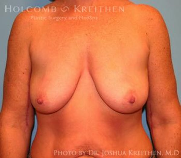 Breast Augmentation with Lift Before & After Gallery - Patient 6276480 - Image 1