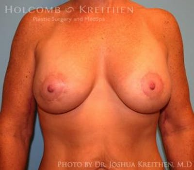 Breast Augmentation with Lift Before & After Gallery - Patient 6276480 - Image 2