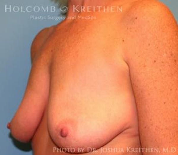 Breast Augmentation with Lift Gallery - Patient 6276480 - Image 3