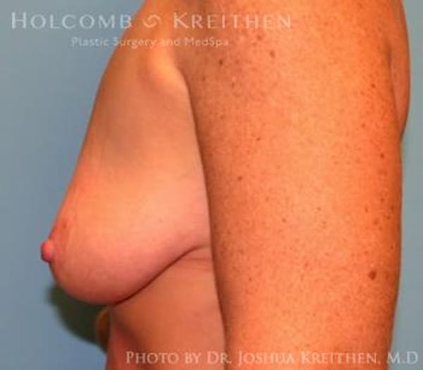 Breast Augmentation with Lift Before & After Gallery - Patient 6276480 - Image 5
