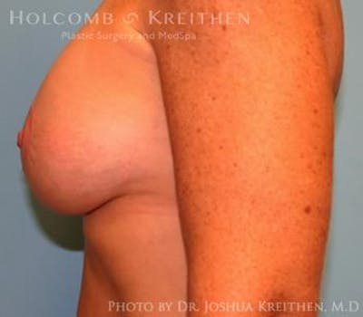 Breast Augmentation with Lift Before & After Gallery - Patient 6276480 - Image 6