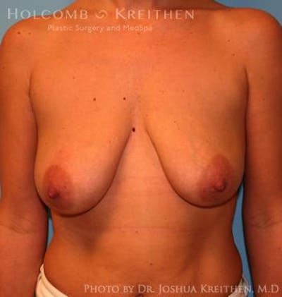 Breast Augmentation with Lift Before & After Gallery - Patient 6276482 - Image 1
