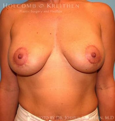 Breast Augmentation with Lift Gallery - Patient 6276482 - Image 2