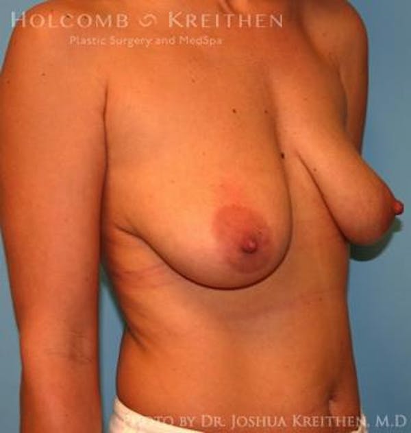 Breast Augmentation with Lift Gallery - Patient 6276482 - Image 3