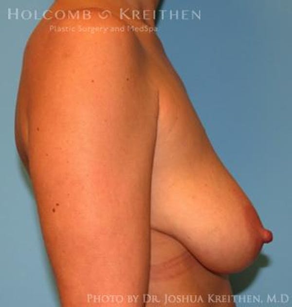 Breast Augmentation with Lift Before & After Gallery - Patient 6276482 - Image 5
