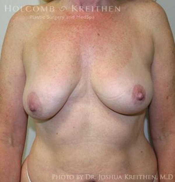 Breast Augmentation with Lift Before & After Gallery - Patient 6276483 - Image 1