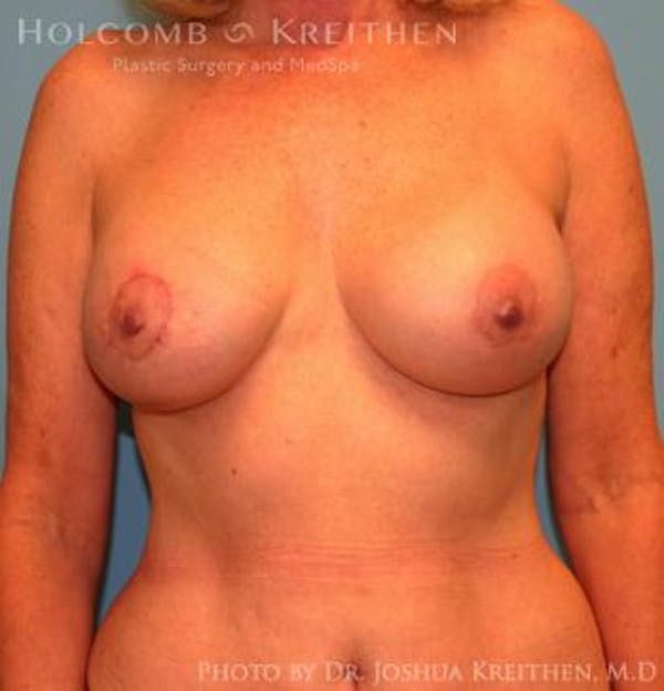 Breast Augmentation with Lift Gallery - Patient 6276483 - Image 2
