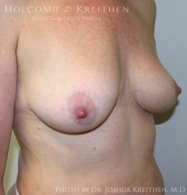 Breast Augmentation with Lift Before & After Gallery - Patient 6276483 - Image 3