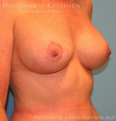 Breast Augmentation with Lift Before & After Gallery - Patient 6276483 - Image 4