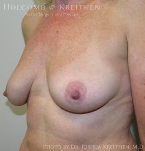 Breast Augmentation with Lift Before & After Gallery - Patient 6276483 - Image 5