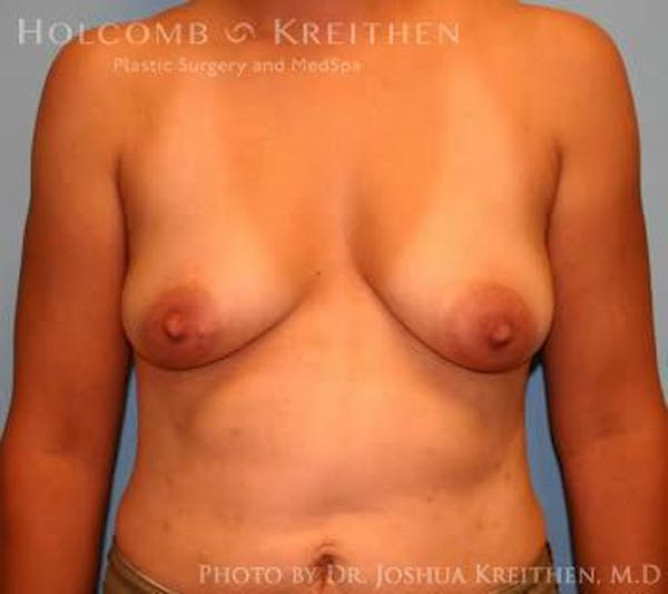 Breast Augmentation with Lift Before & After Gallery - Patient 6276487 - Image 1